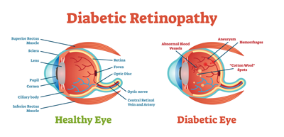 Diaabetic retinopathy